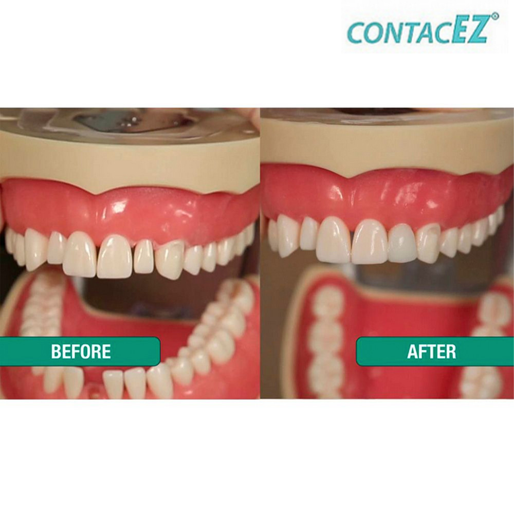 32pcsDental ContacEZ Strips Kit For Veneers Finishing Set Restorative Crown