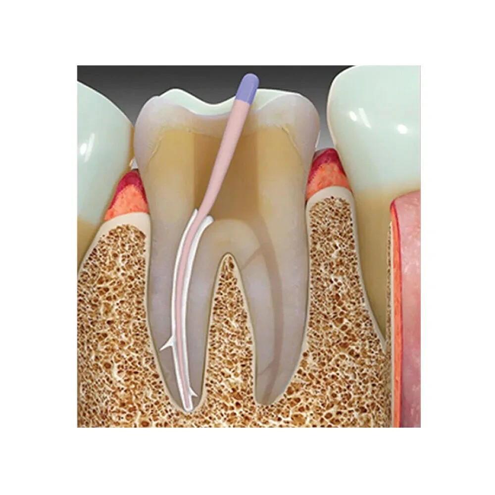Prime Dental MTA Bioceramic Root Canal Sealer Syringe Tips for Dental Procedures