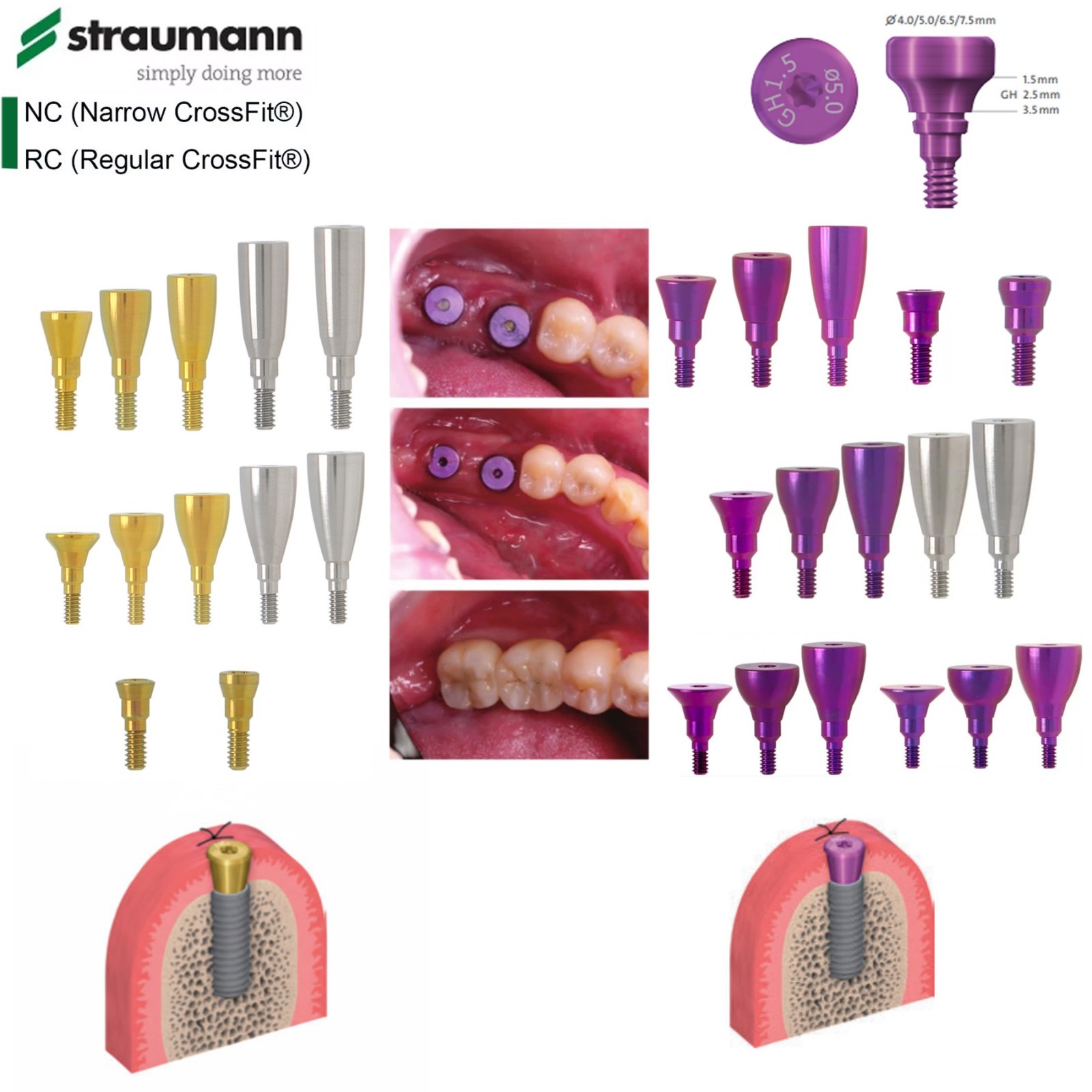 5Pcs ITI Titanium Healing Abutment & Closure Cap Screw Straumann BL / BLT NC/RC