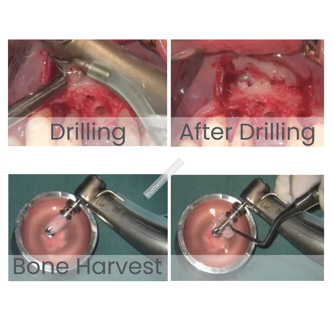 φ2.8 Dental Bon Harvest Spring Drill Trephine Bur Self-grinding Collector