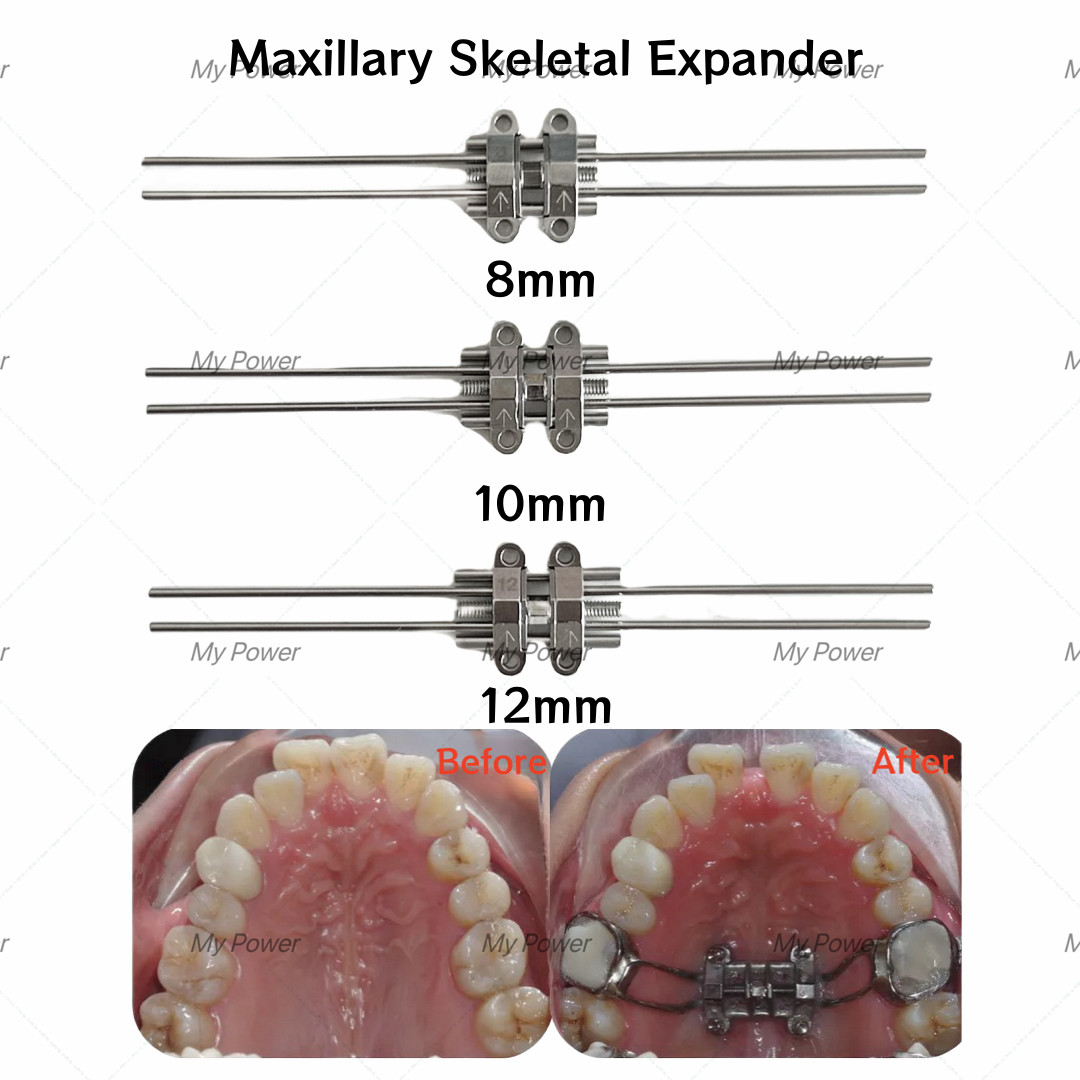 Dental Expansion Screw Rapid Split Skeletal Fixation Screws/MSE Expander/Driver