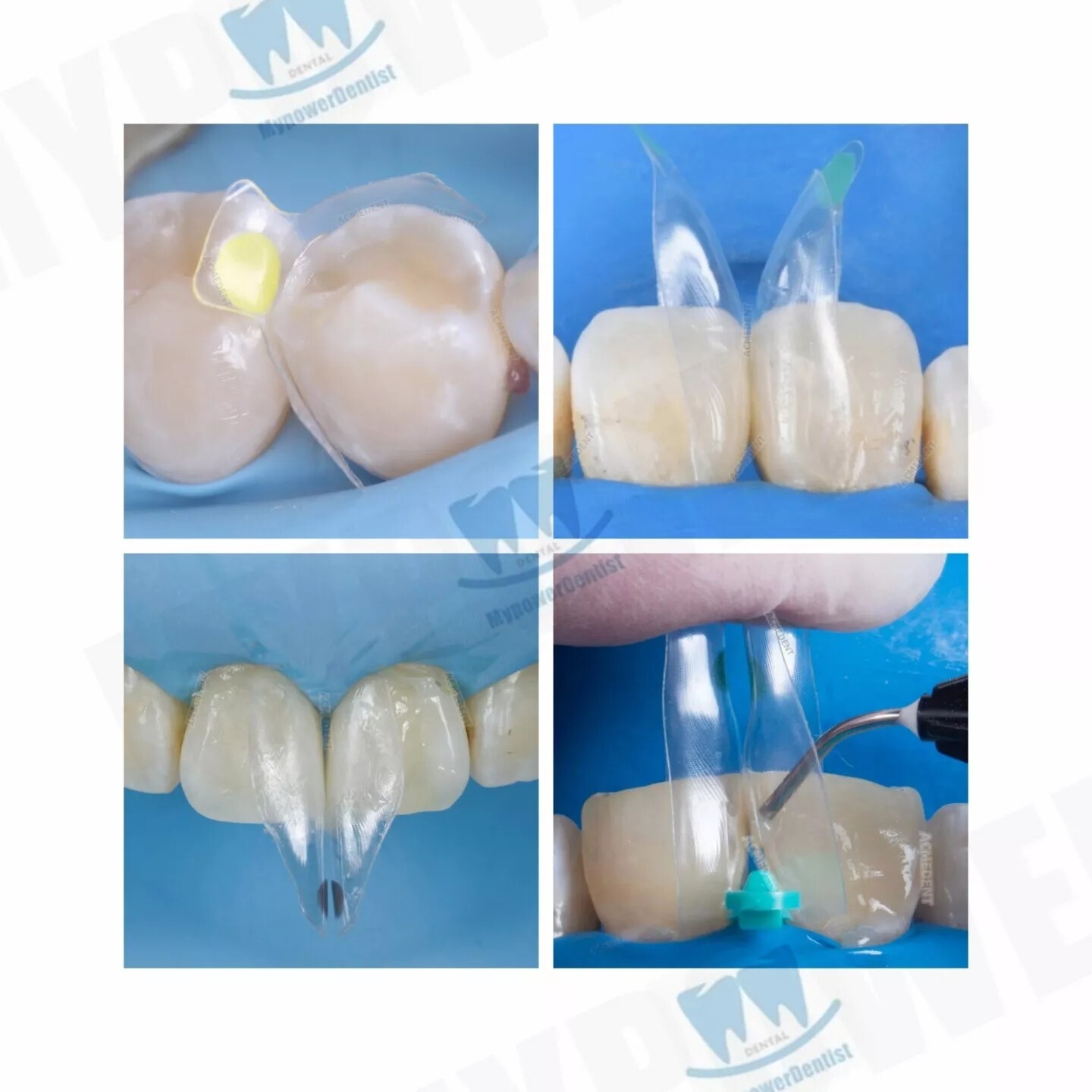 Dental Clear Matrix Diastema Matrices Wedges Similar with BioClear Matrice
