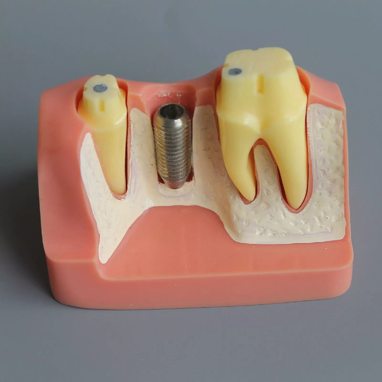 2Pc Dental Oral Analysis Crown Bridge Demonstration Tooth 4 Times Model Typodont