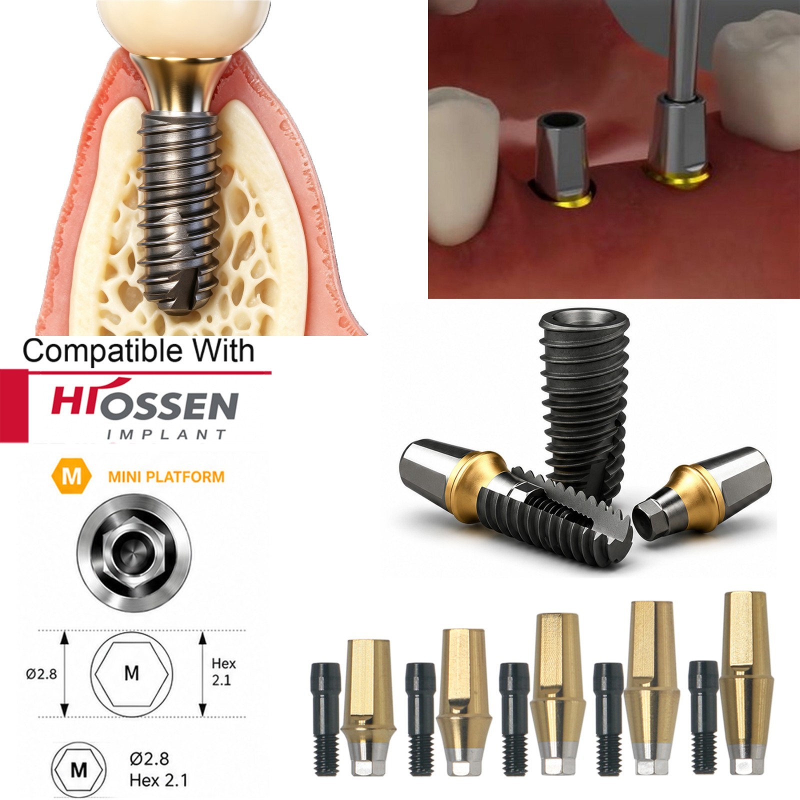 US Fit Hiossen ET / Osstem TS Dental Titanium Abutments & Restorative Components