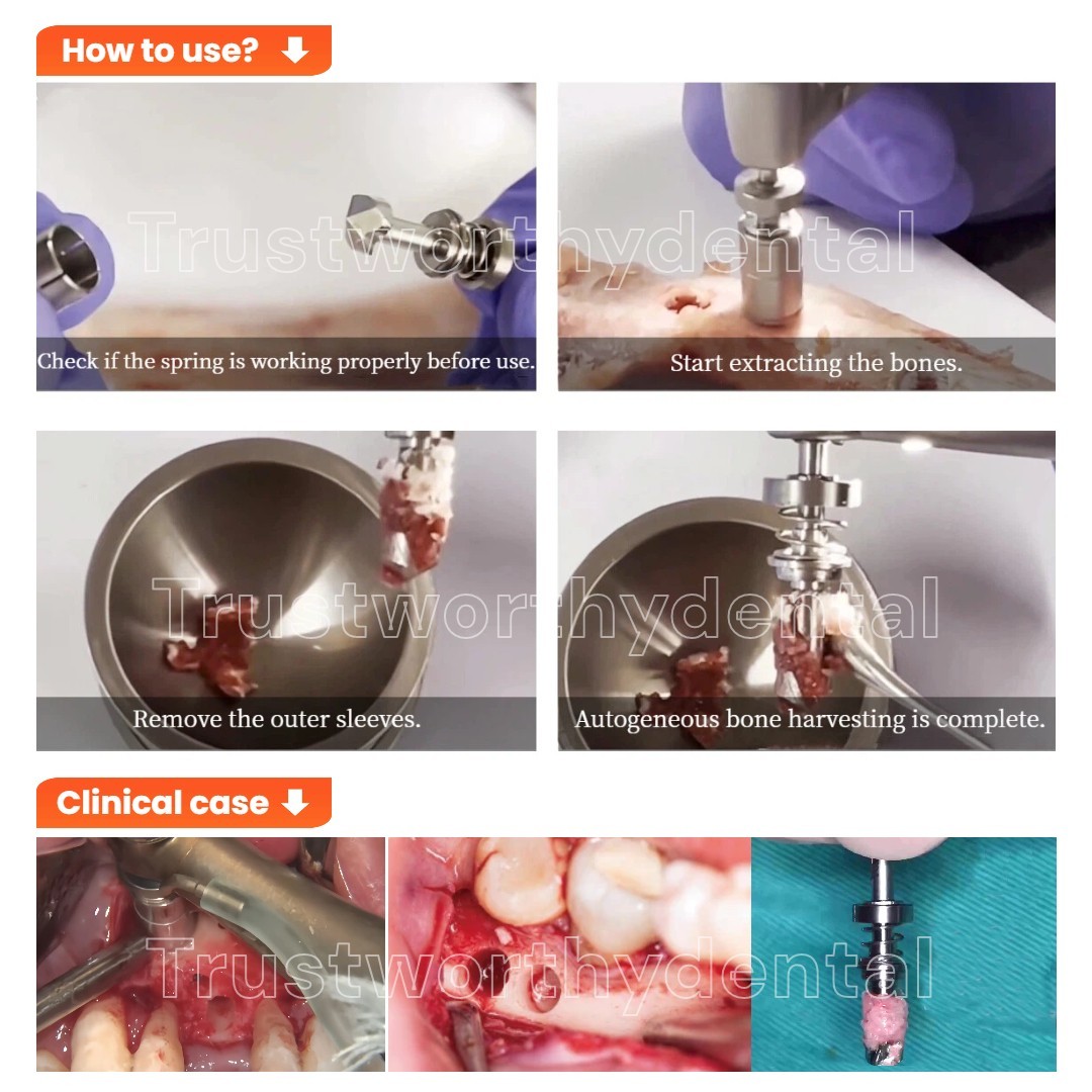 Dental Autogeneous Bon Collector GBR Self Bon Harvest Drill Spring Bonesier US