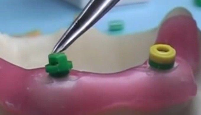 DSI Dental Lab Fixture OT Box Micro Castable Overdenture Ball Attachment Kit