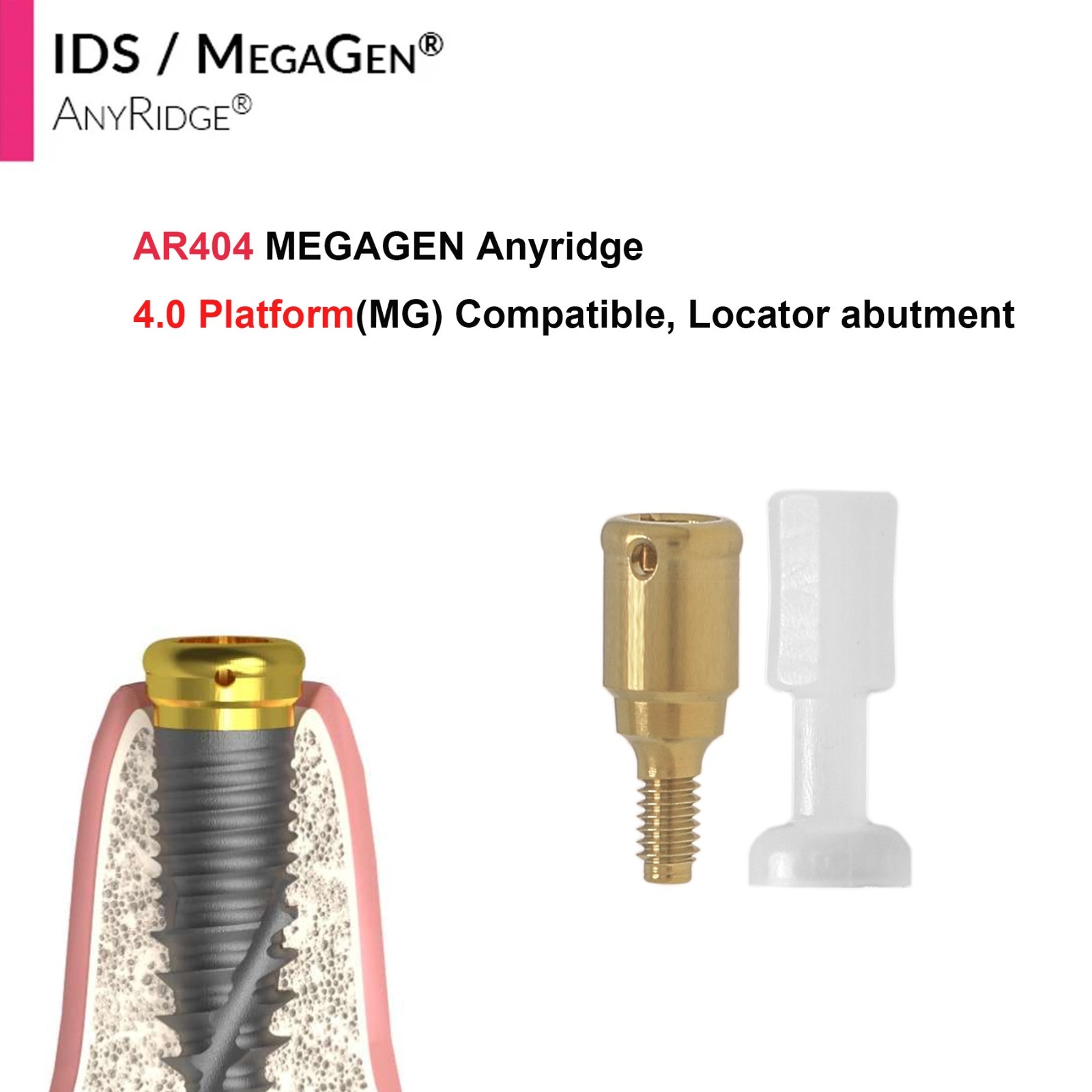 Implant Fit Zest Locator Abutment Hiossen/Nobel/Zimmer/GM/MegaGen /Straumann