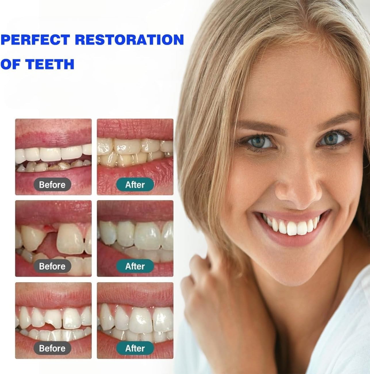 Effective Temporary Tooth Repair Kit – Zinc Oxide for Affordable Smiles – 2PCS