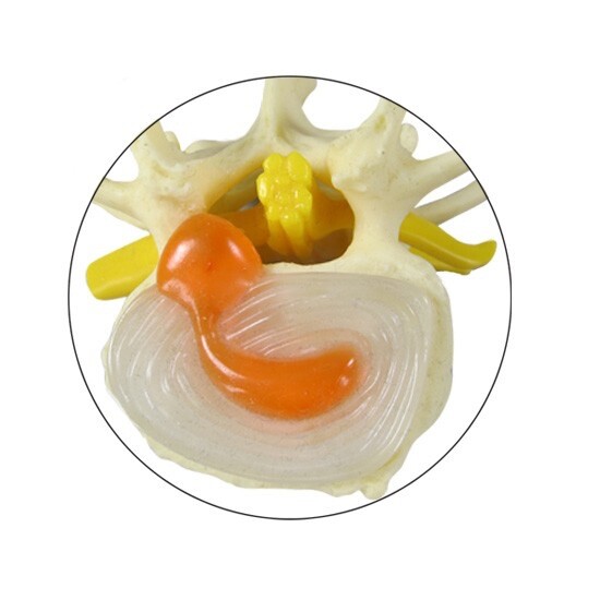 GPI Anatomical #1760 4-Stage Vertebrae Osteoporosis Model Herniated Disc