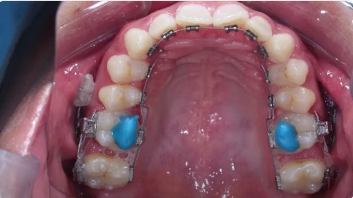 Dental BITE UP LC BLUE Composite 4gm a Superior Bite Raising Composite