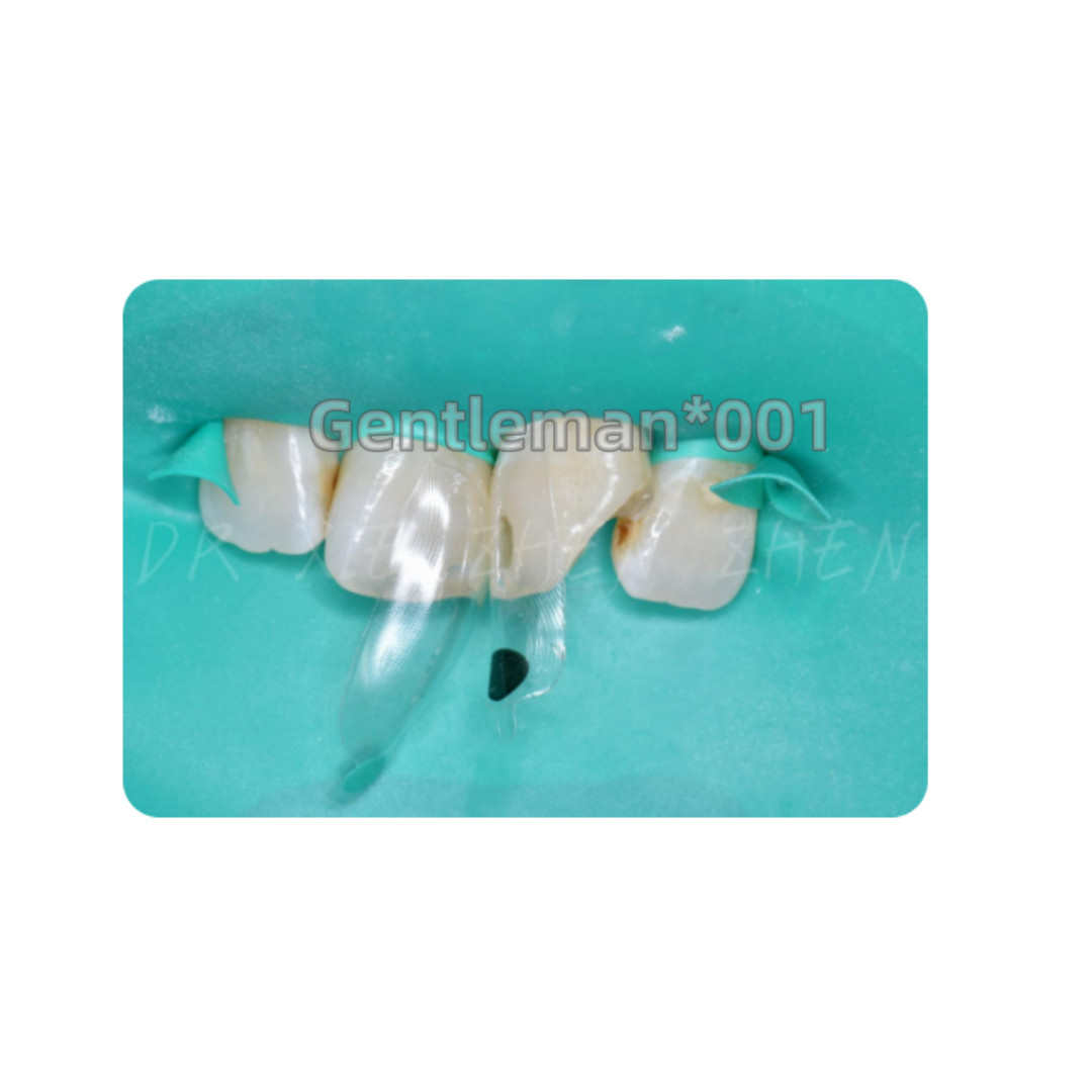 35pcs Dental Clear Matrix Anterior Restorative BT Bow Matrices Fit BioClear