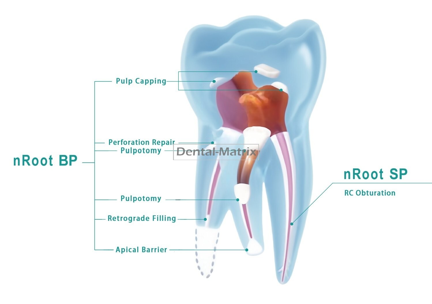 Root Canal Bioceramic Repair BP Restorative Material Filling Cement Sealer SP