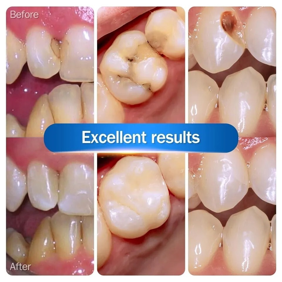 Dental Composite Resin Light Cure White Veneer Hybrid Aesthetic teeth resin 2.5g