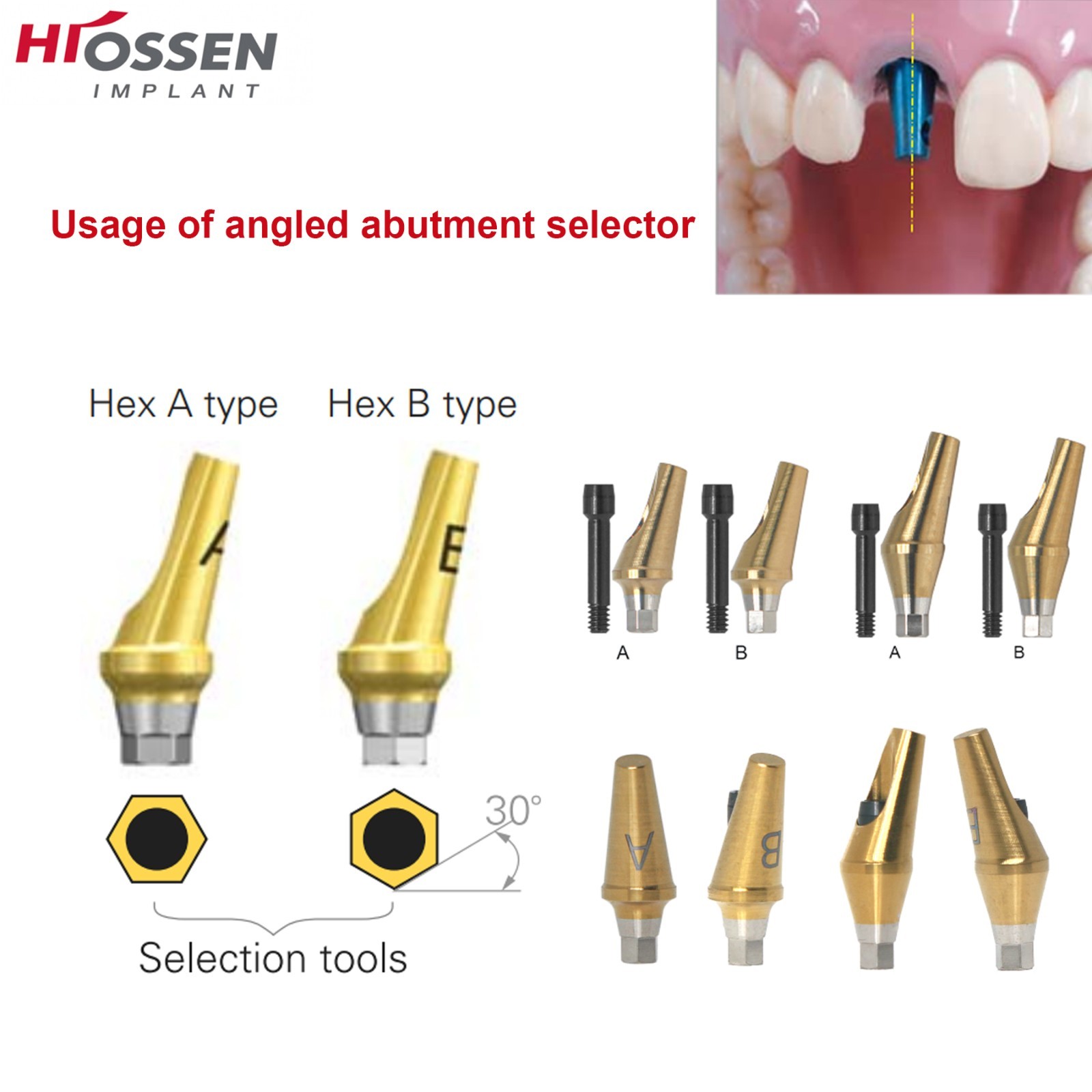 US 17° Dental Angled Anatomic Abutment Hex Compatible with Hiossen ET/Osstem TS
