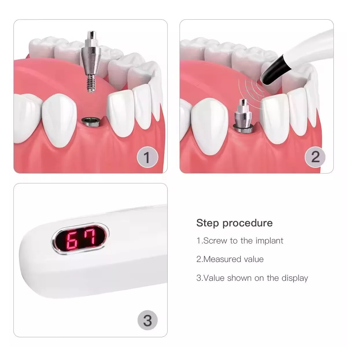 Dental Implant Osseointegration Implant Stability Measurement Monitor Tester USA