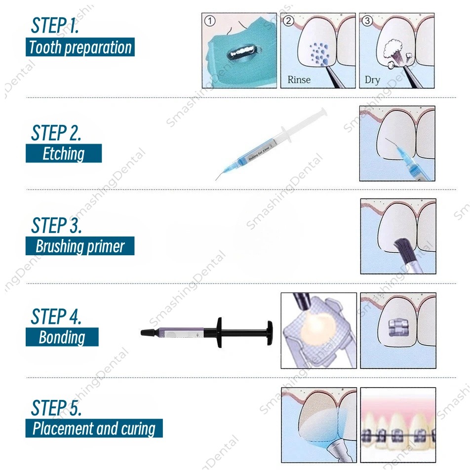 Dental Bracket Braces Glue Orthodontic Bonding Light Cure Resin Composite Kit
