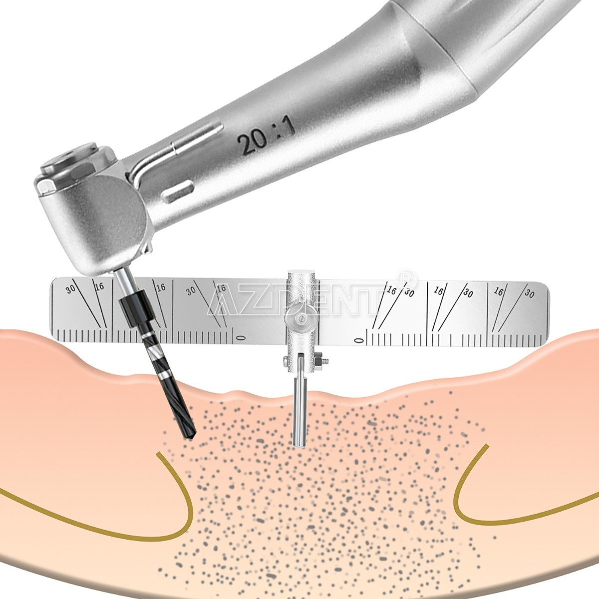 Dental Implant Locating Guide Surgical Planting Positioning Locator Angle Ruler