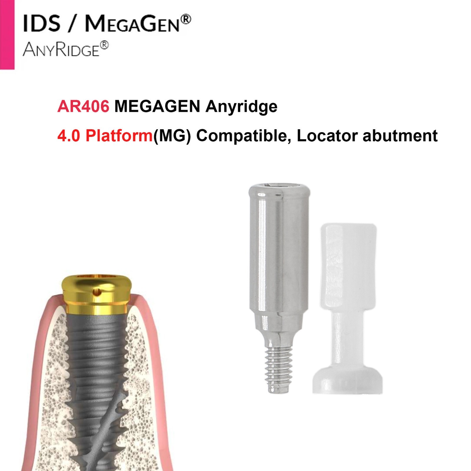 Implant Fit Zest Locator Abutment Hiossen/Nobel/Zimmer/GM/MegaGen /Straumann