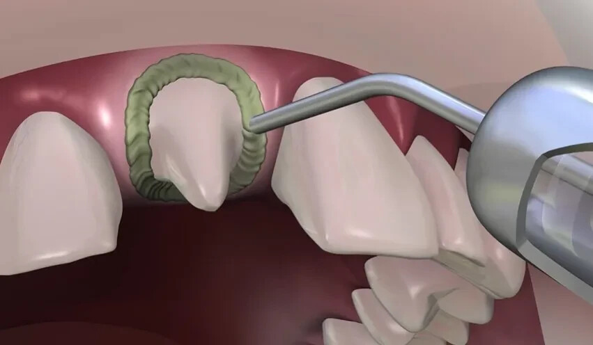 Dental HEMOSTAL GEL a Hemostatic Gel to stop minor gingival bleeding 3g Syr