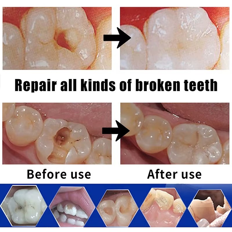 Dental Cement resin glue Tooth Filling Fixation Powder Liquid Zinc Phosphate Set