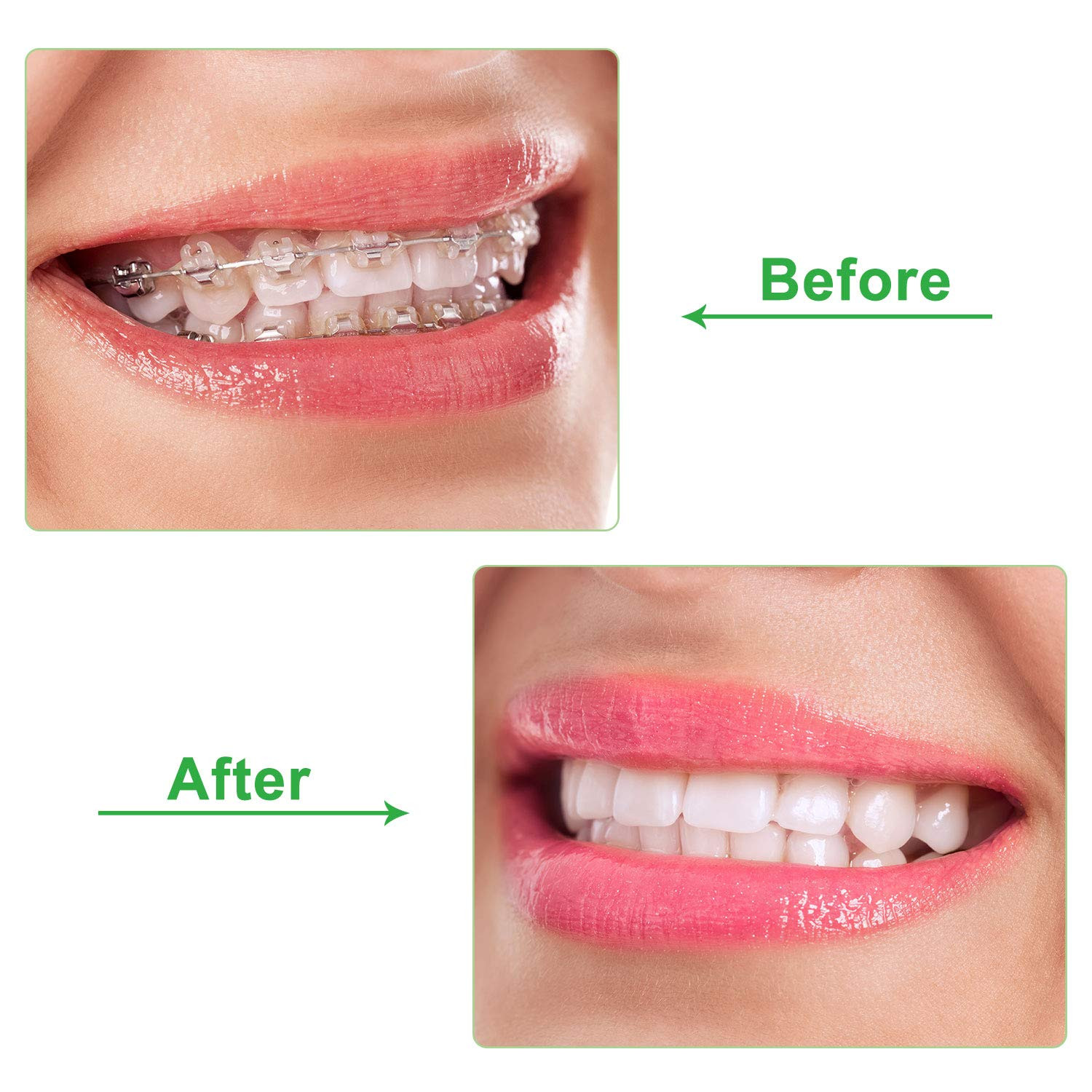 10 Green Aligner Trays Seater – 10 Pack Orthodontic Dental Aligners