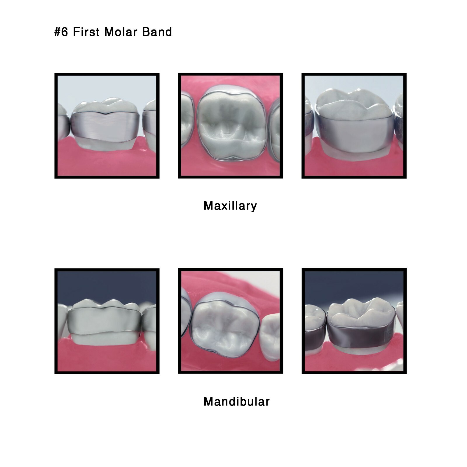J&J Ortho™ Orthodontic #6 First Molar Band Quadrant (4/pk) Optional Size
