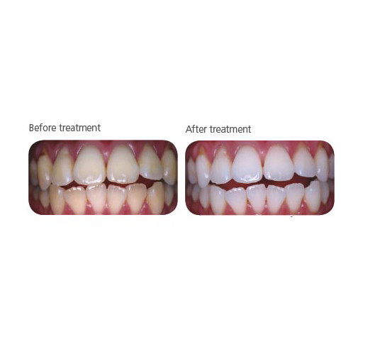 SDI PolaOffice ADVANCED TOOTH WHITENING SYSTEM Exp: 2023-12