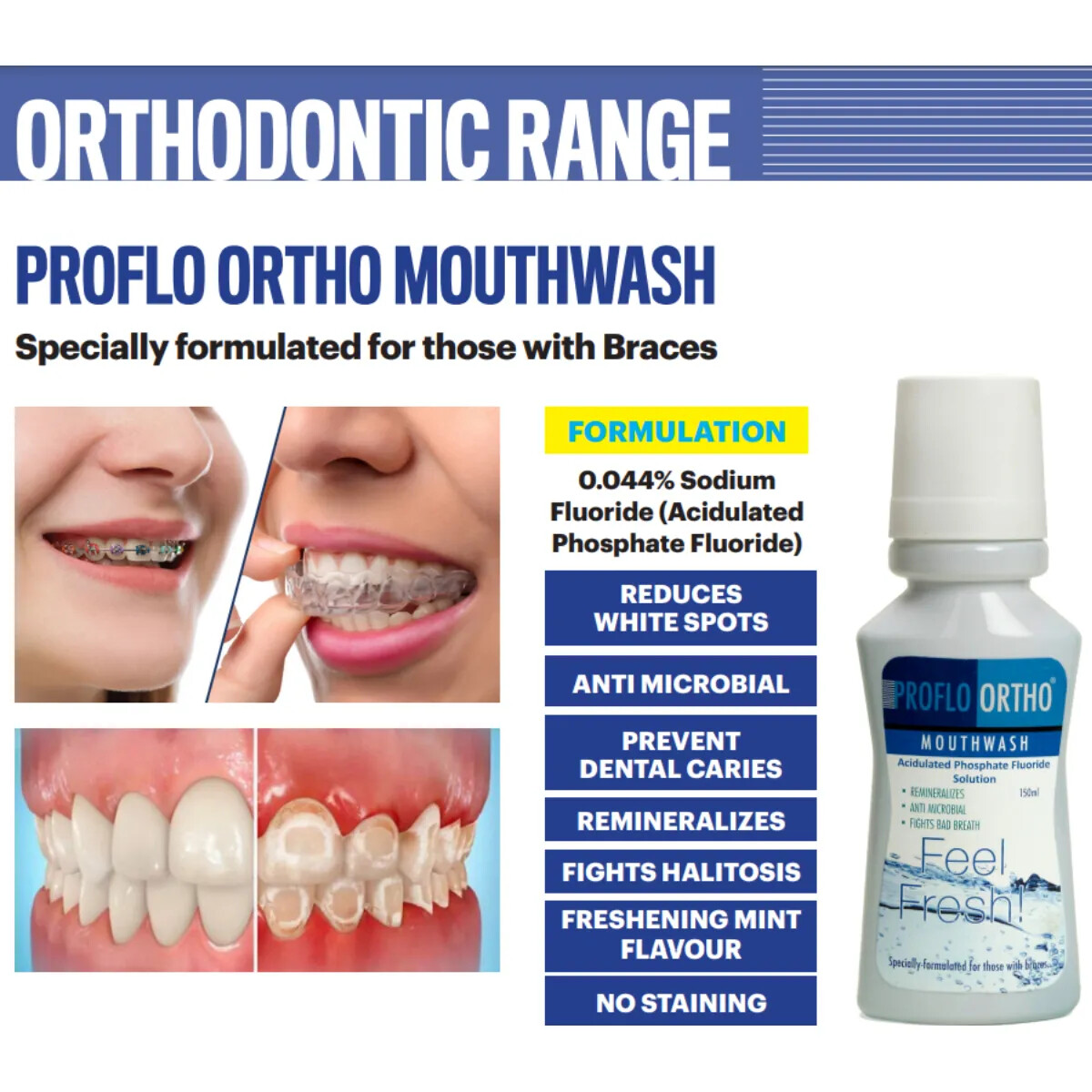 Sandika Pharma Proflo Acidulated Mouthwash (Pack of 12) Free Shipping….