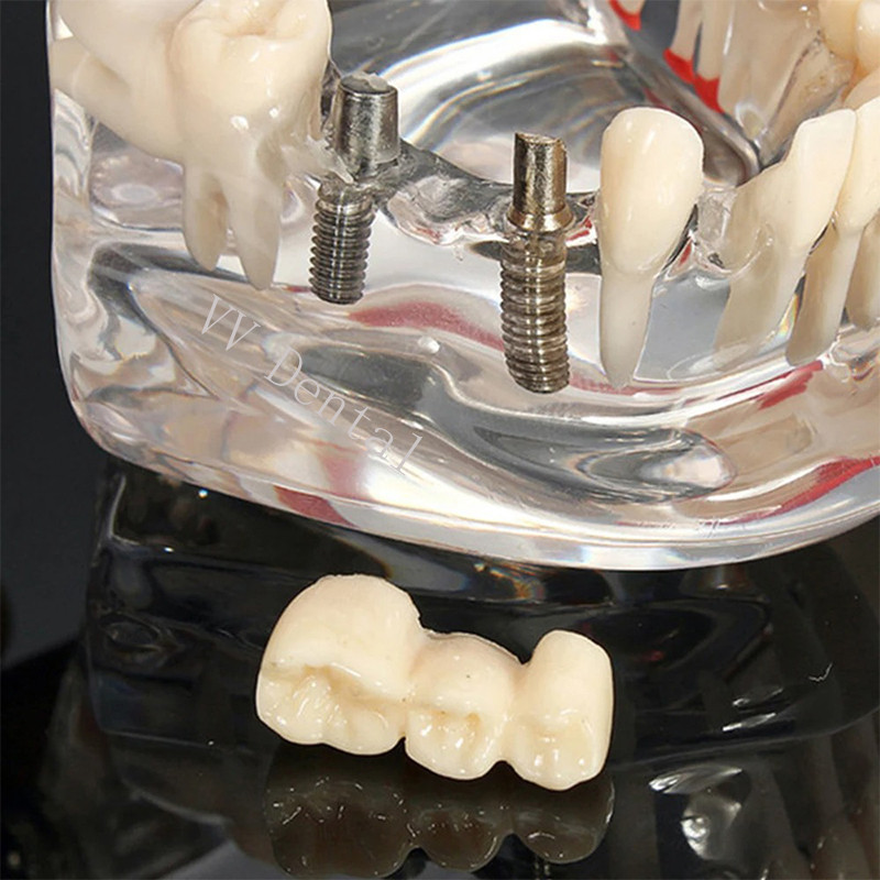 Dental Disease Model Teeth Teach Study Oral Teeth Bridge Restoration Pathology