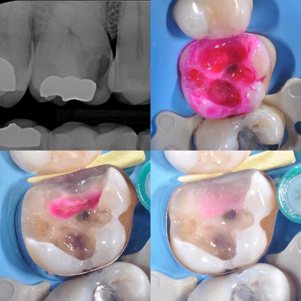 Kuraray Caries Detector