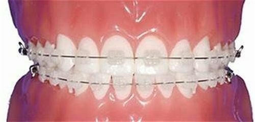 Ceramic Twin Brackets, MBT, .022, 20/Kit, Modern Arch