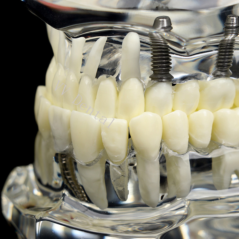 Dental Disease Model Teeth Teach Study Oral Teeth Bridge Restoration Pathology