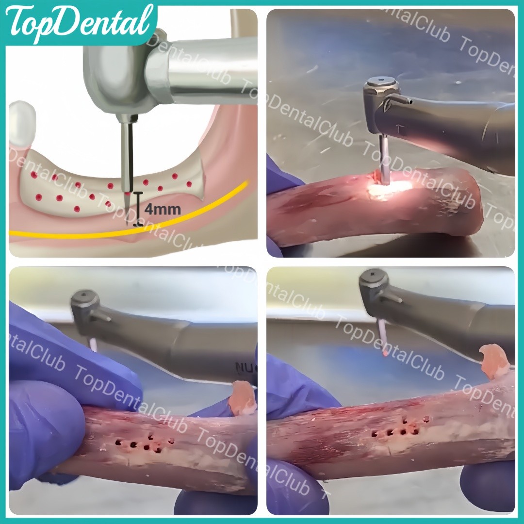 Dental Nutrient Drill Tack GBR Bone Augmentation Nourishing Hole Drills Implant