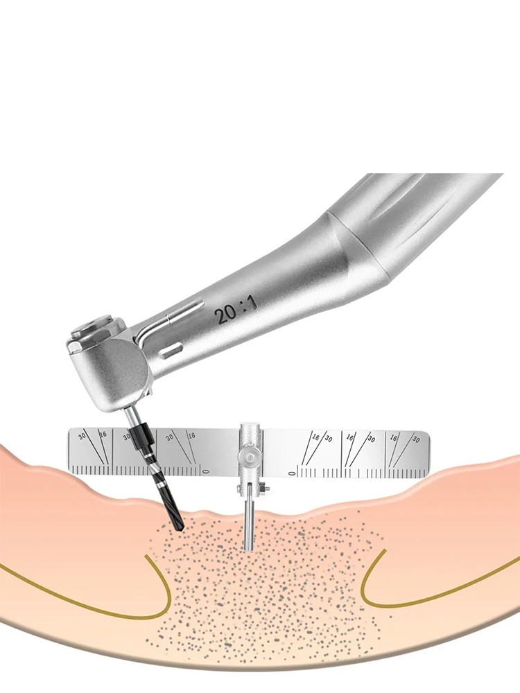 Dental Implant Locating Guide Surgical Planting Positioning Locator Angle Ruler
