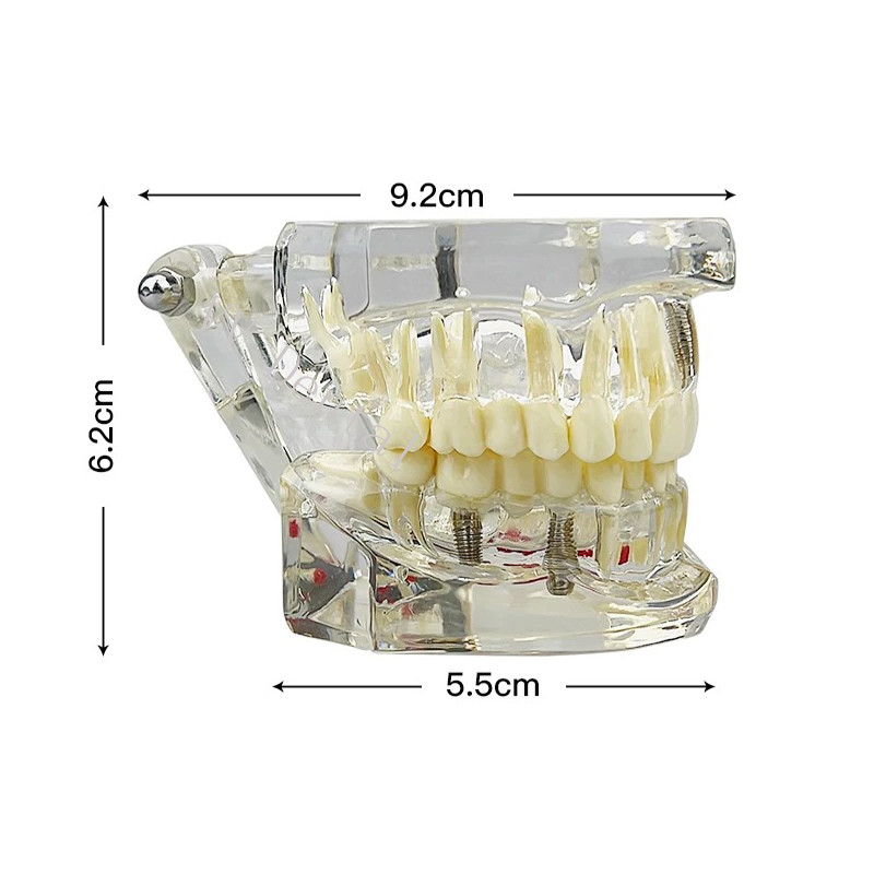 Dental Disease Model Teeth Teach Study Oral Teeth Bridge Restoration Pathology