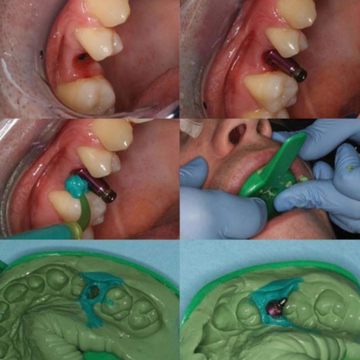 Dentaltech Closed/Open Tray Impression Copings Nobel Biocare Implant Compatible