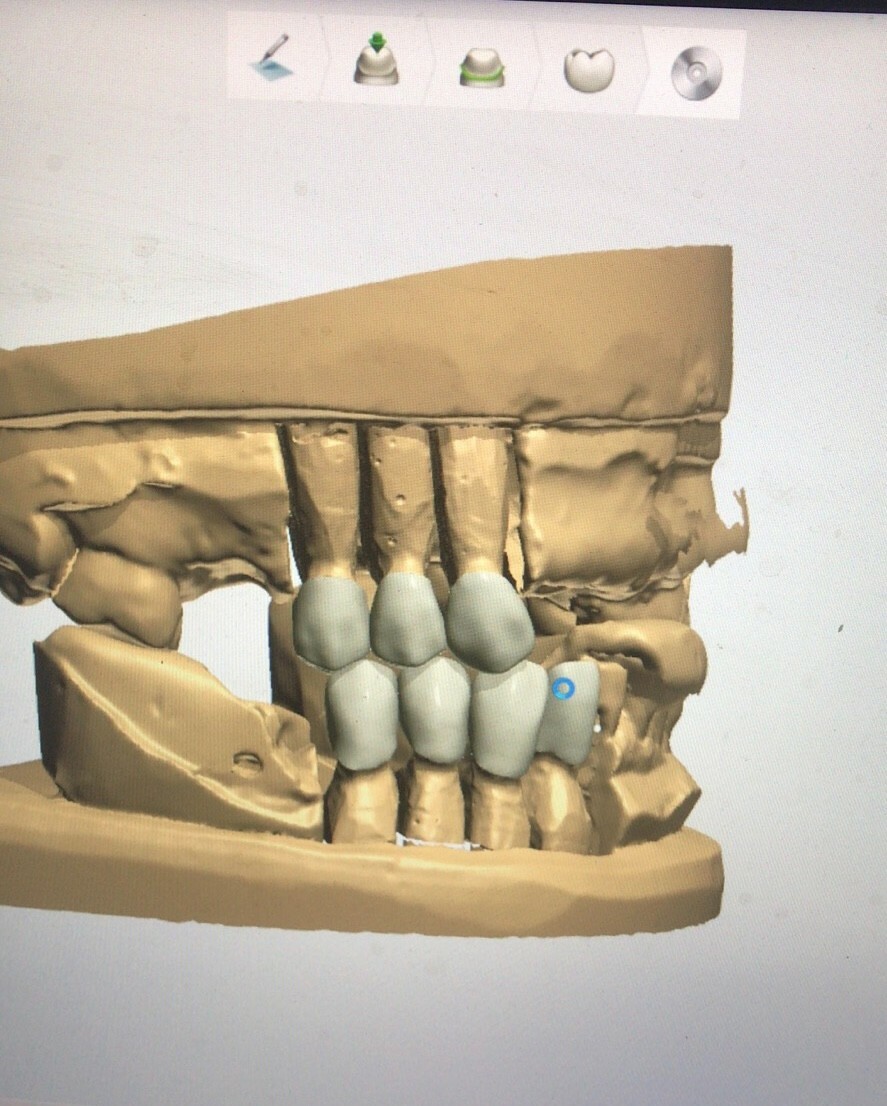 Crown & Bridge & Implant abutment Design Service & Digital CAD/CAM 