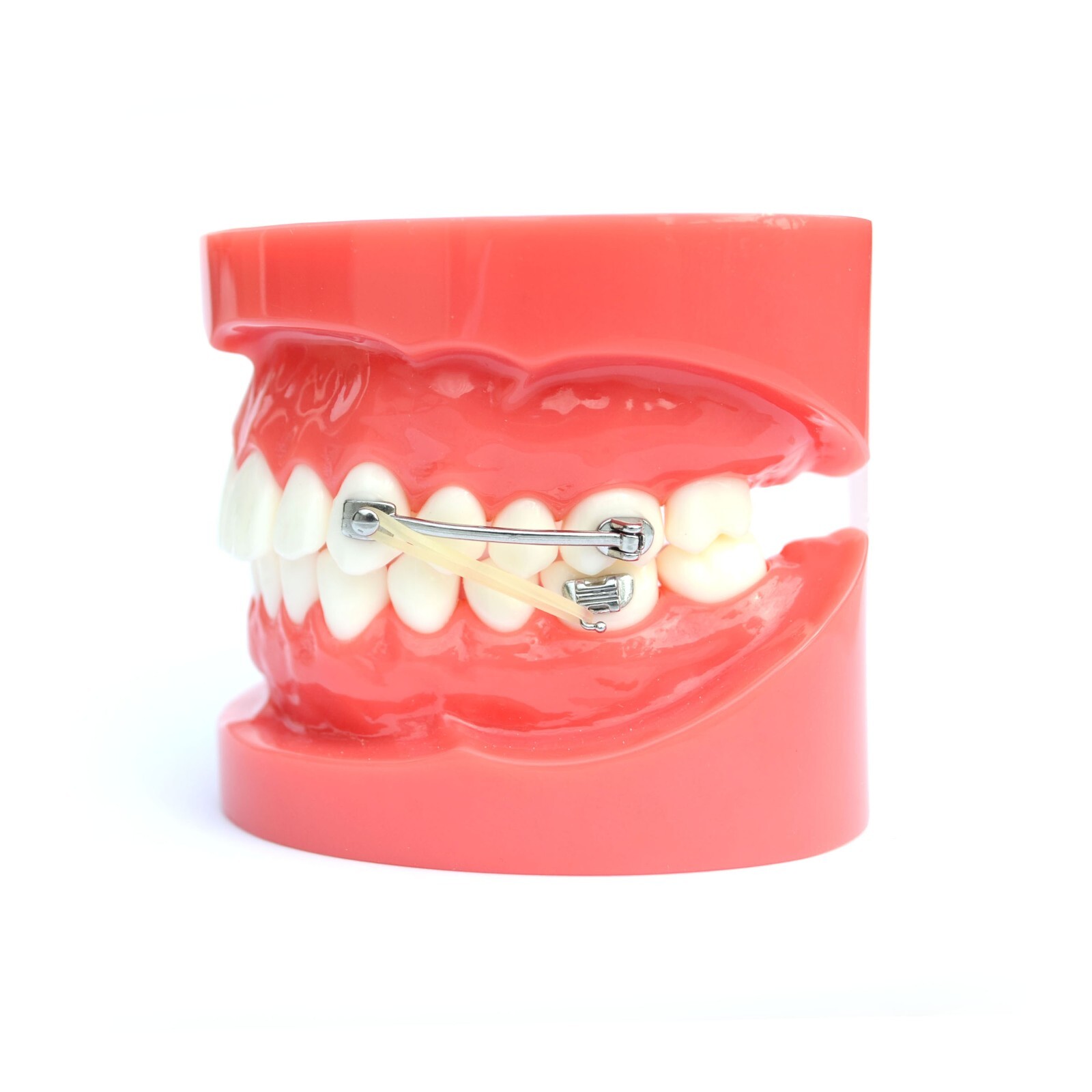 J&J Ortho™ BiteForce™ Orthodontic Bondable Distalizing Bar Appliance (2/pair)
