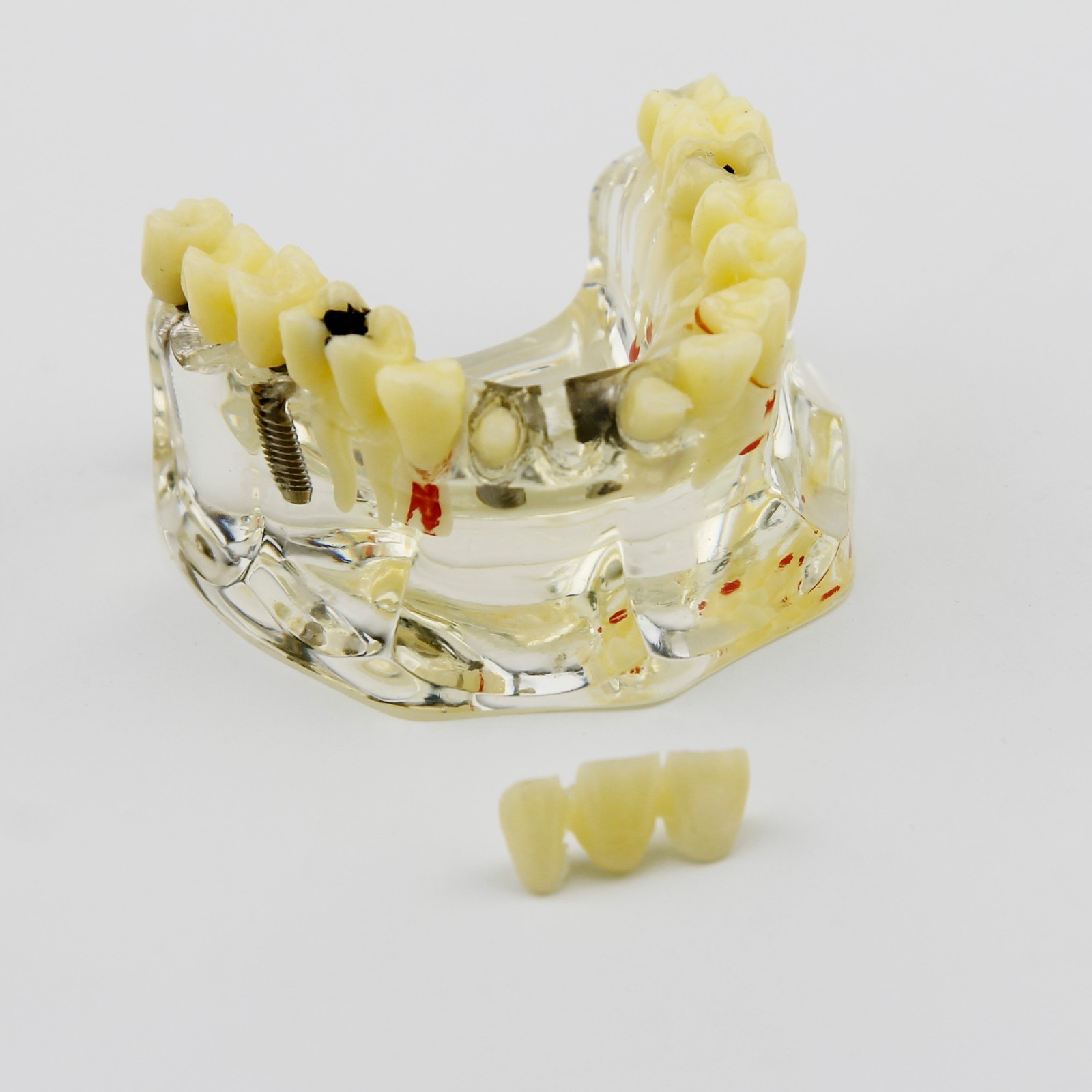 Dental Upper Jaw Implant Model with Bridge and Caries -I 2006