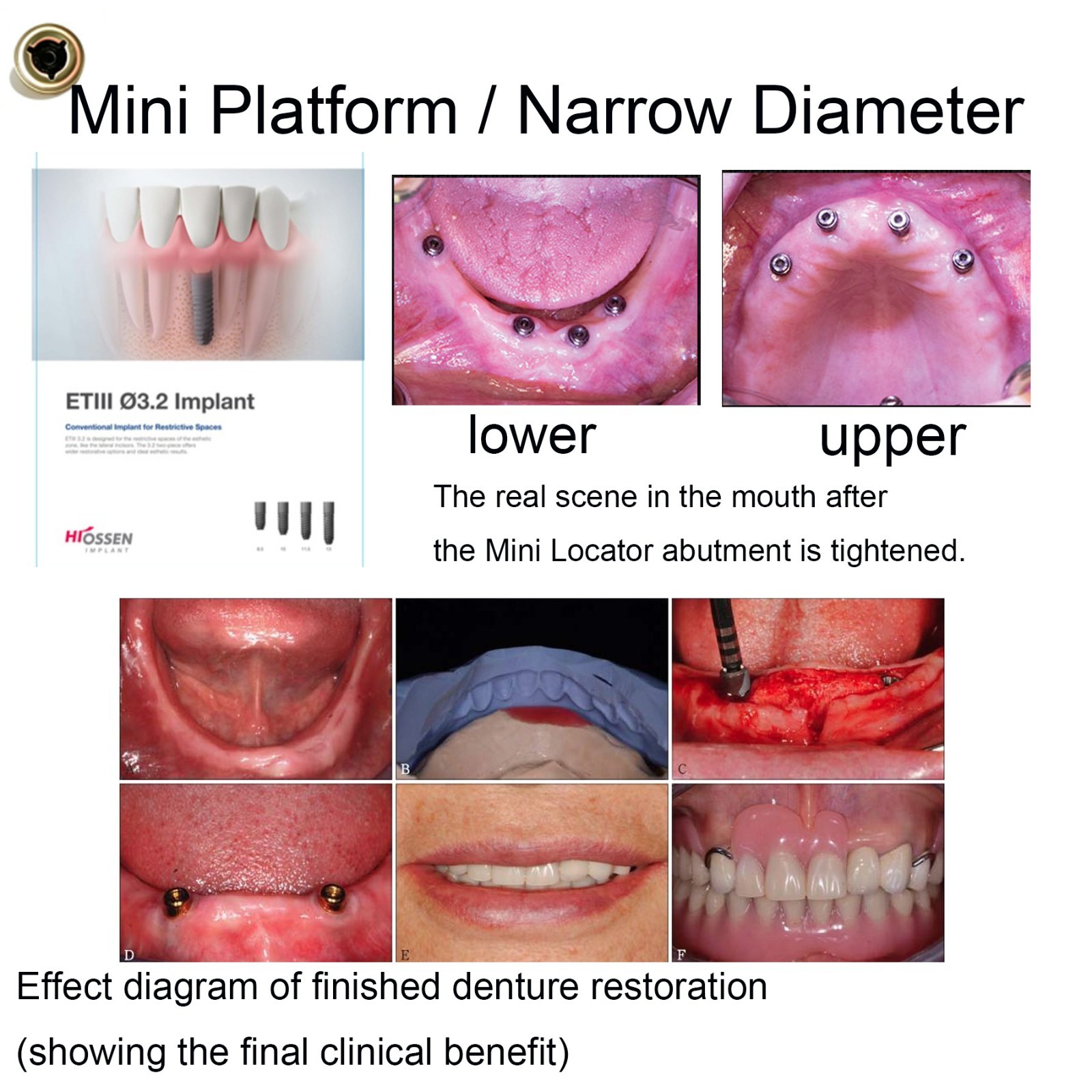 US Dental LOCATOR Titanium Abutment for HIOSSEN ET/TS Fixture Hex Mini Platform