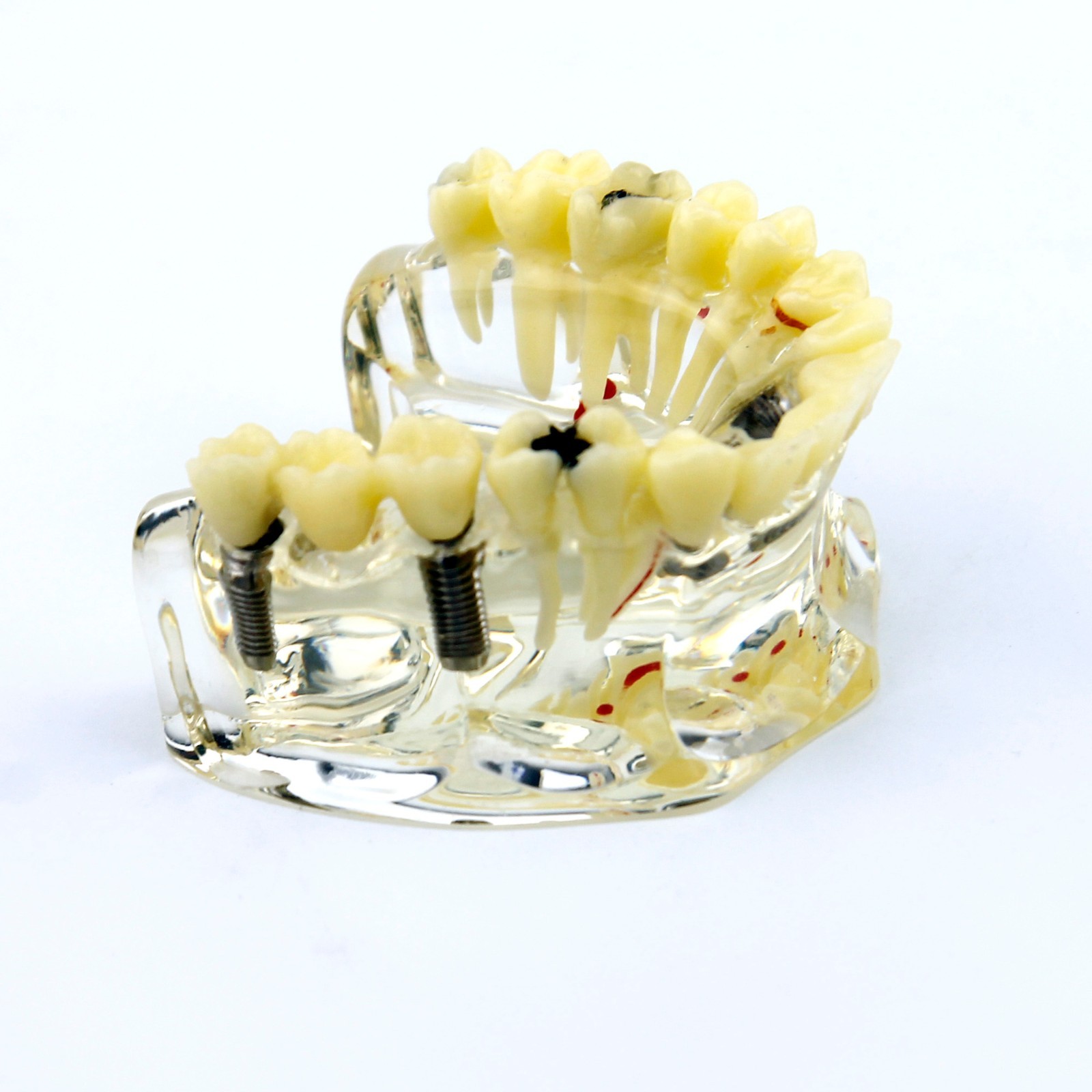 Dental Upper Jaw Implant Model with Bridge and Caries -I 2006