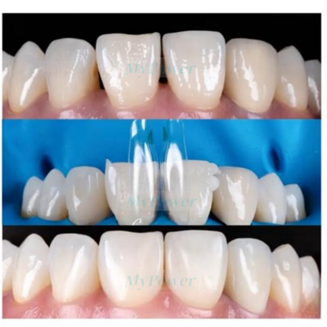 Dental Clear Matrix Diastema Matrices Wedges Similar with BioClear Matrice