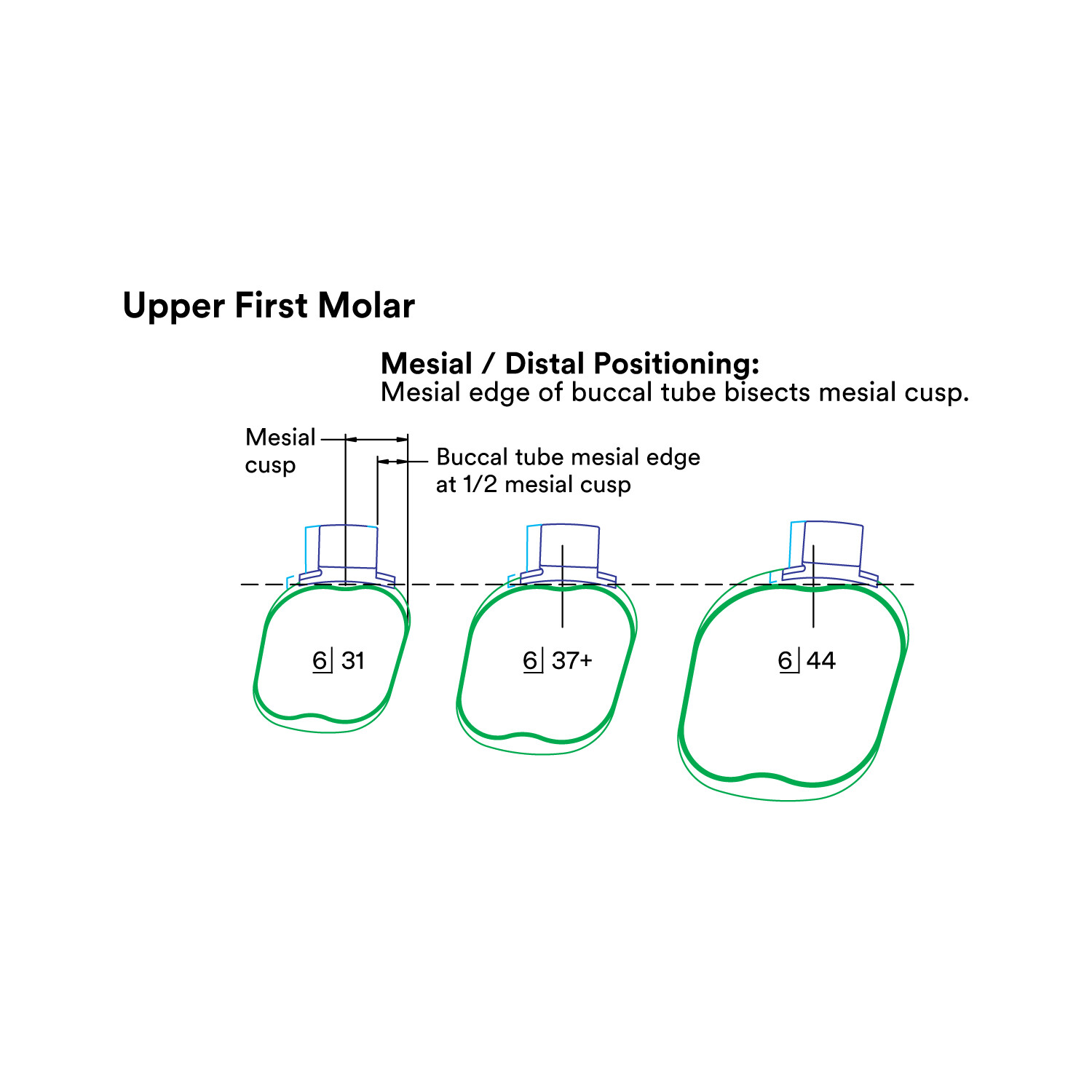 J&J Ortho™ Orthodontic #6 First Molar Band Quadrant (4/pk) Optional Size