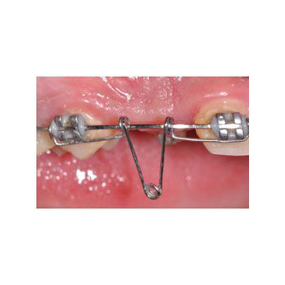 J&J Ortho Orthodontic Double Torsion Spring (Kilroy Spring Equivalent) 10/pk