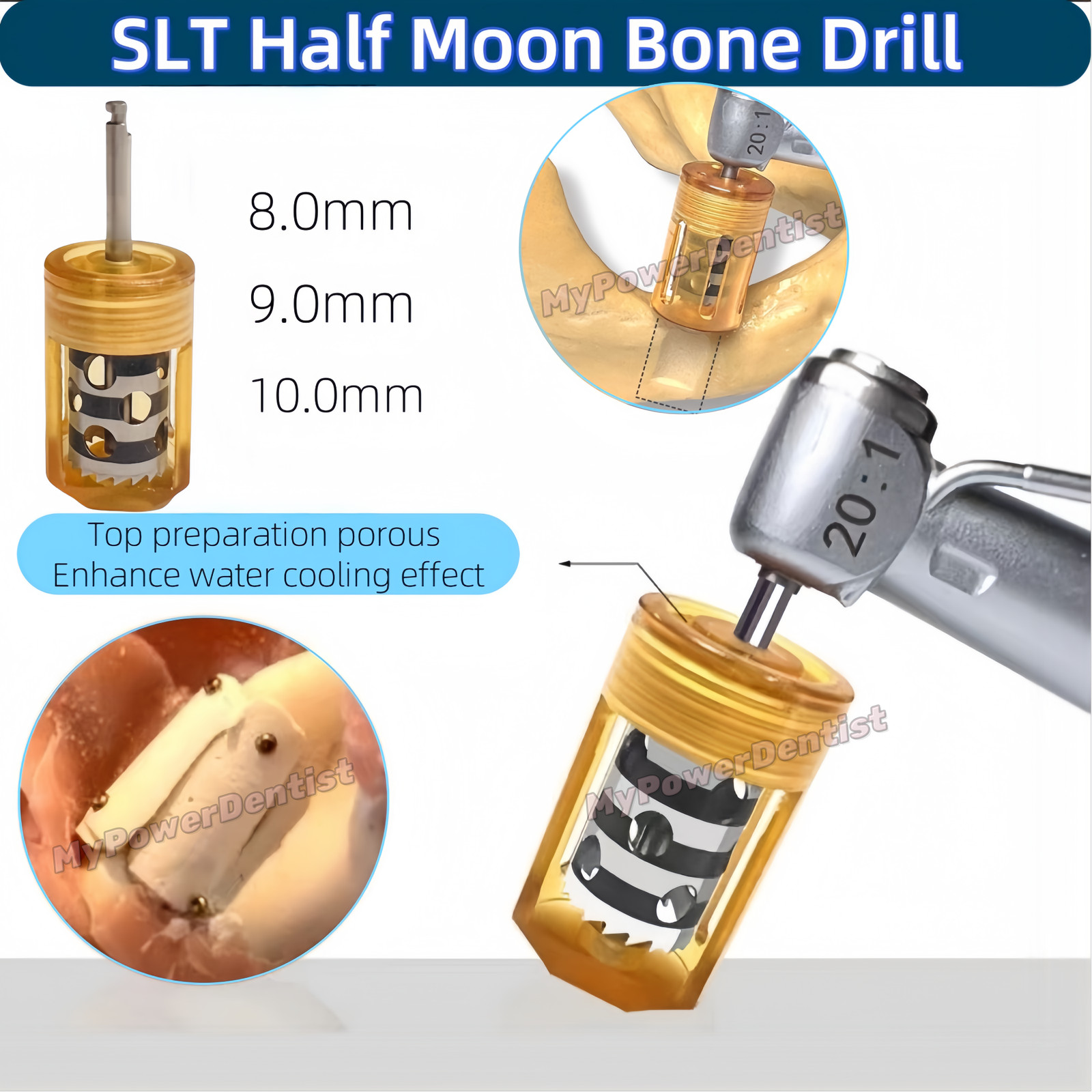 1Set Dental SLT Half Moon Bone Harvest Drill Semilunar Technique Collector Drill