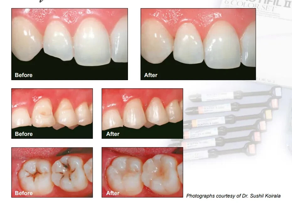 New Shofu Beautifil II Dental Composite Basic Kit With Free Shipping