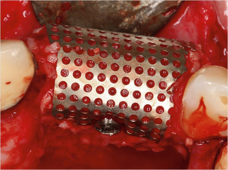 GBR Titanium Mesh Membrane Plate Bon Tack Barrier 44x44mm, Dental Im plant