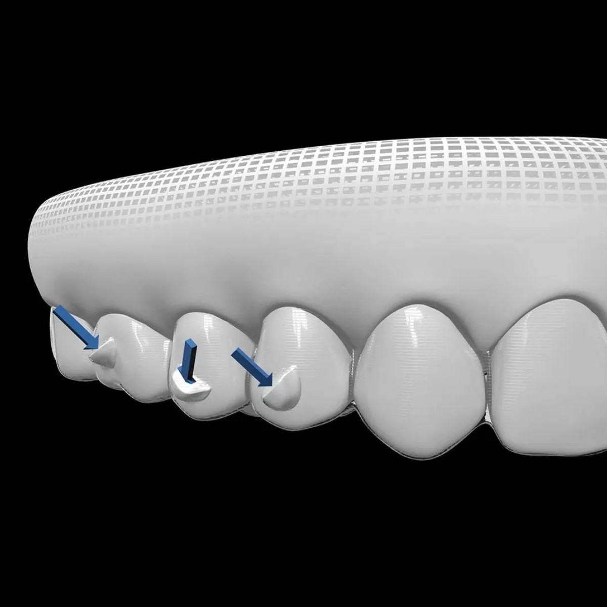 DentAct Aligner Fix Orthdontic Adhesive For Aligner Attachments ( Transparent )