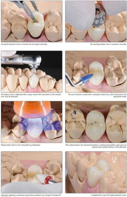 A16 Dental Lithium Disilicate Glass Ceramic Blocks with Positioning Holes Open