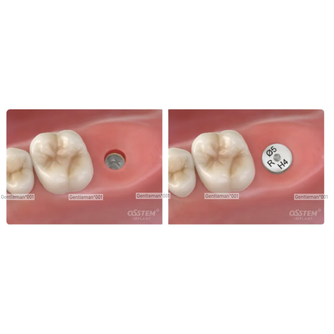 Dental Healing Abutment/Lab Analog Mini Regular Platform Cap Fits Osstem Hiossen